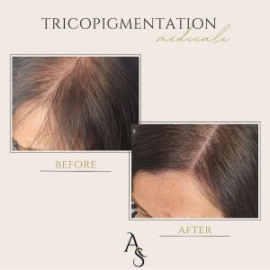 Tricopigmentation