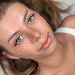 Taches de rousseur