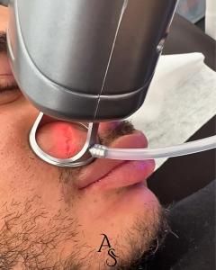 Traitement au Laser CO₂