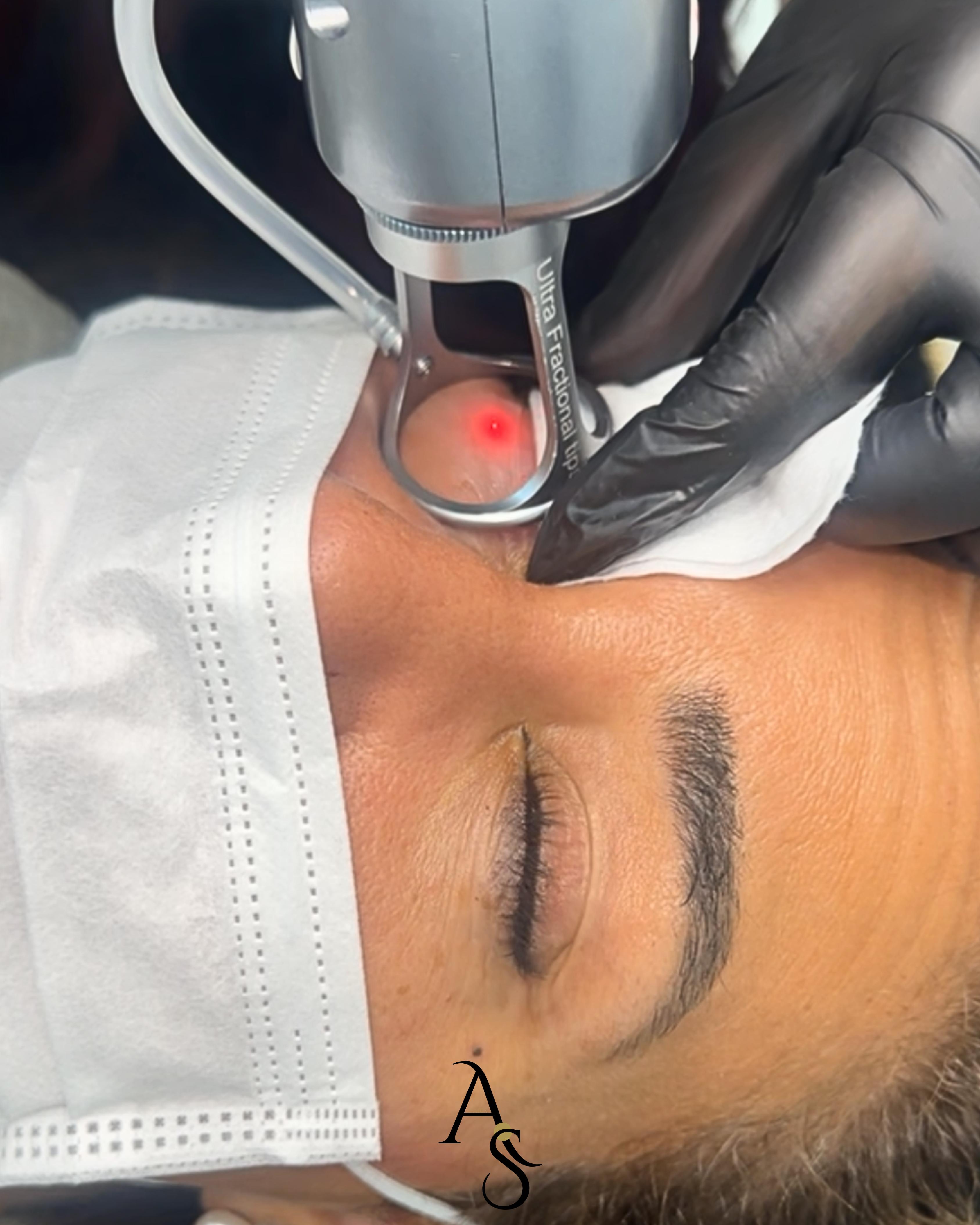 Traitement au Laser CO₂